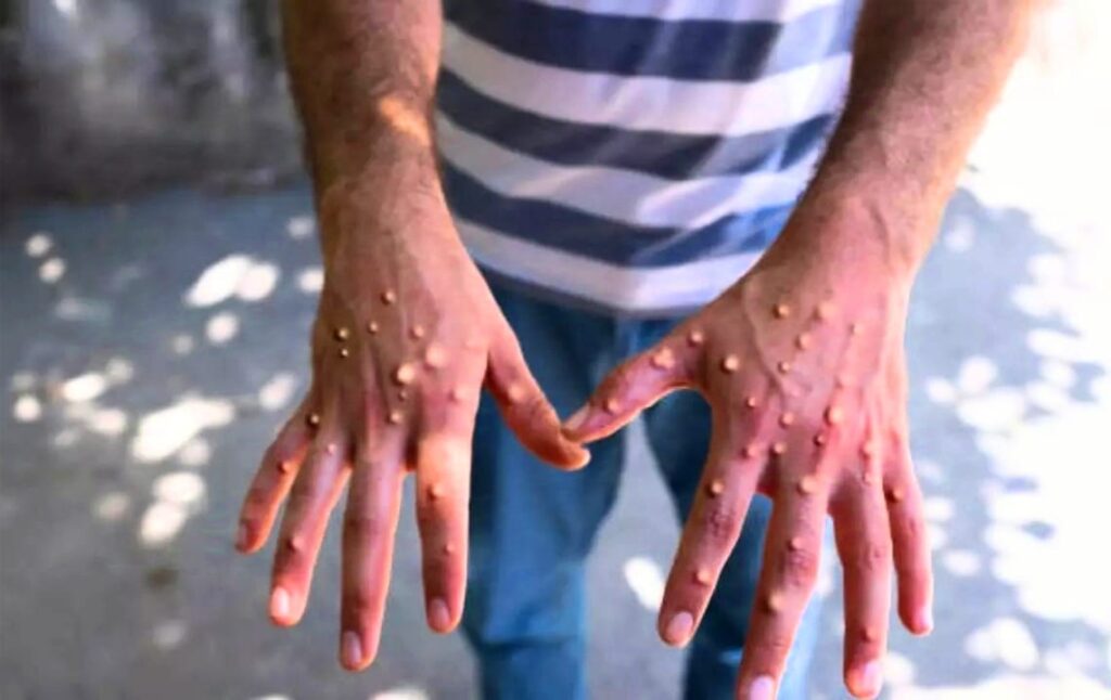 Mpox Cases in Congo Show Signs of Stabilizing, but Additional Vaccines Needed to Eradicate Virus