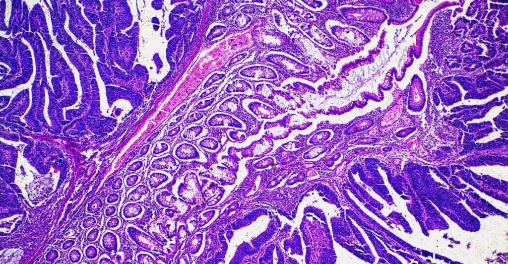 Low-Dose Hair Growth Drug Found Safe for Breast Cancer Patients