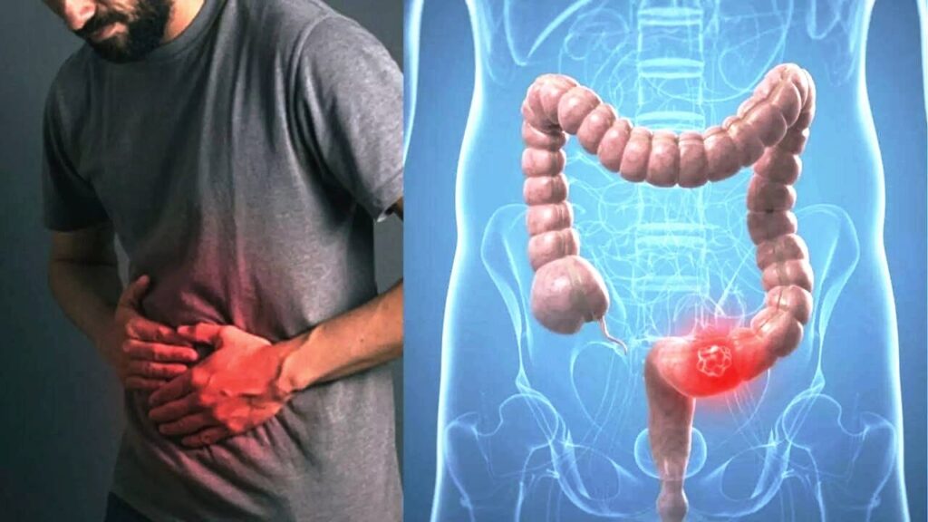 Colon Cancer: Comprehensive Overview, Risk Factors, and Key Insights