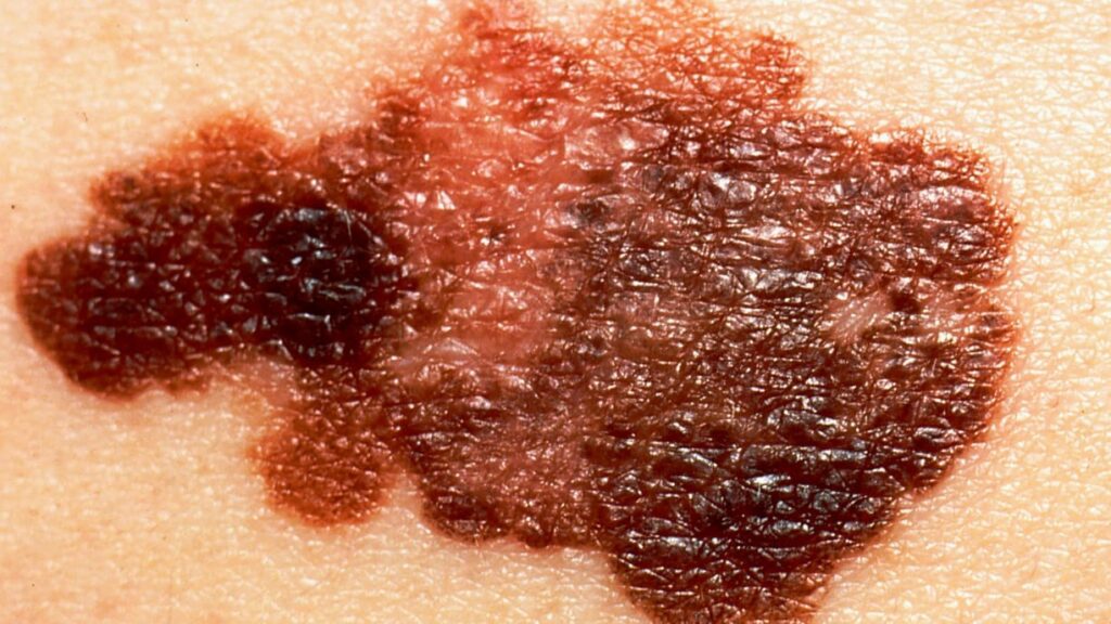 Melanoma Skin Cancer: Key Facts, Early Detection, and Preventive Measures