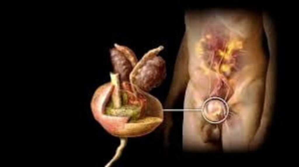 Prostate Cancer Symptoms: Everything You Should Know for Early Detection