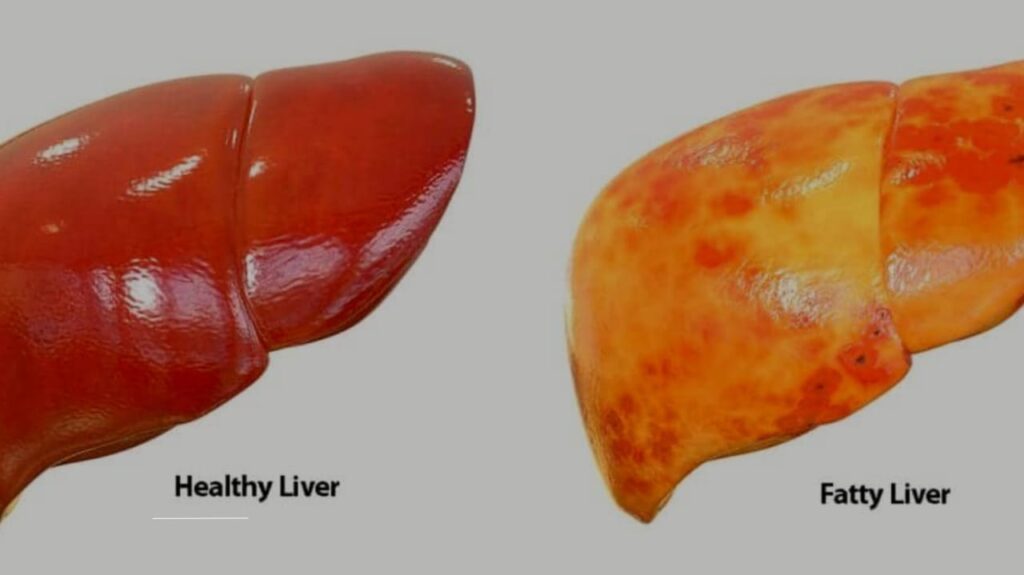 Life Expectancy with Fatty Liver Disease: Understanding Your Prognosis and Options