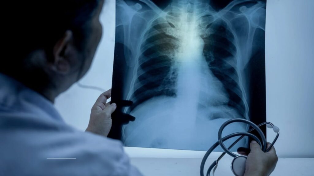 67 Tuberculosis Cases Reported in Kansas: Health Officials Confirm Outbreak Since January