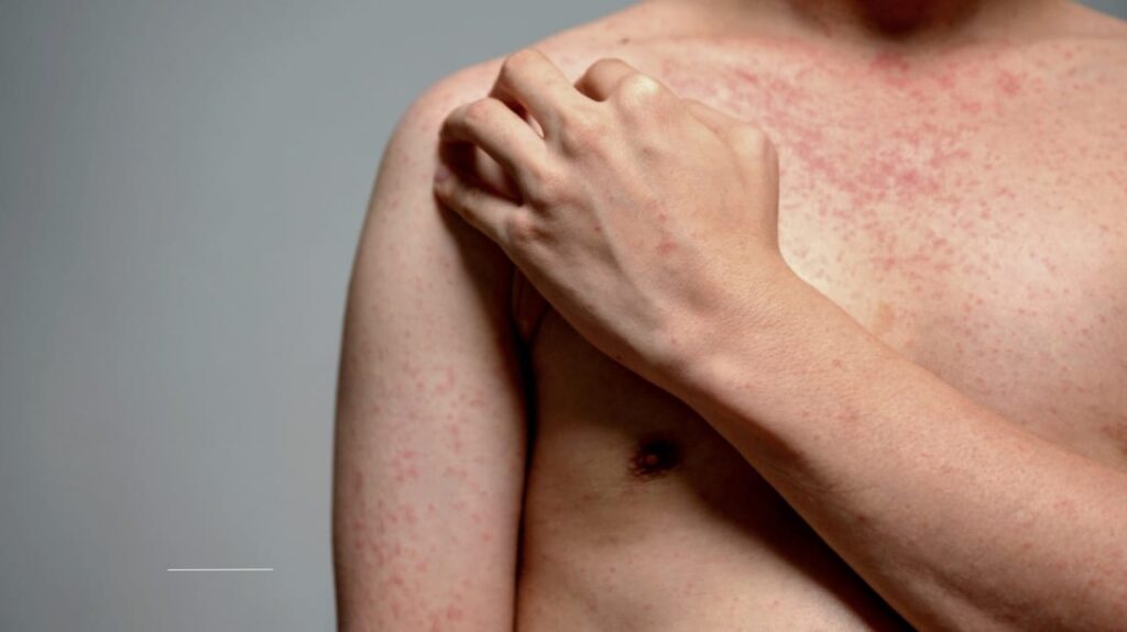 The Growing Need for Measles Vaccine Boosters