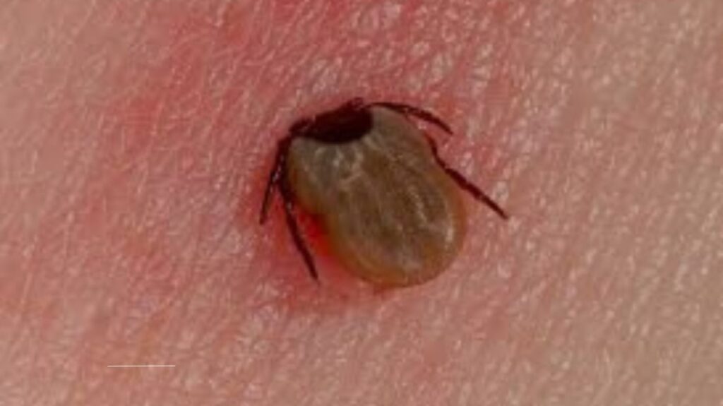 Lyme Disease Misdiagnosis: 5 Conditions Often Confused with Tick-Borne Illness