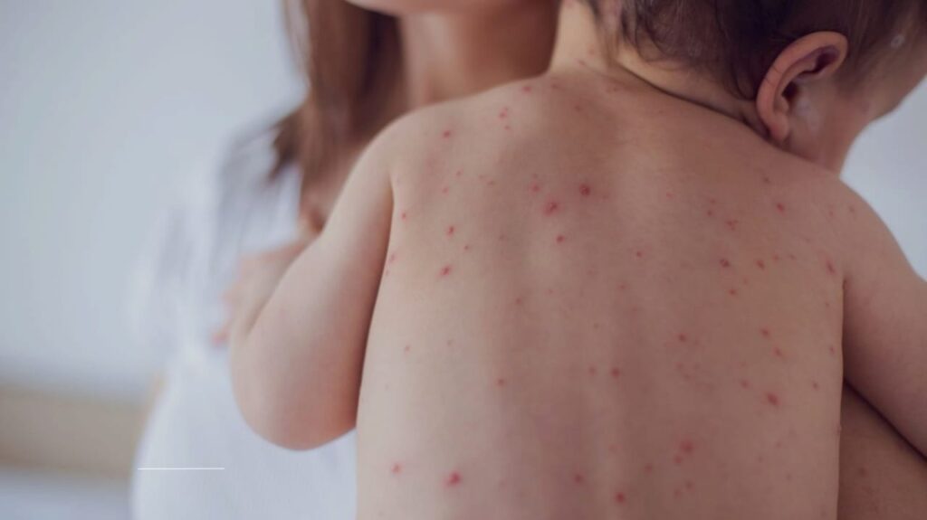 Measles Is Back—Here’s Why Health Experts Are Sounding the Alarm