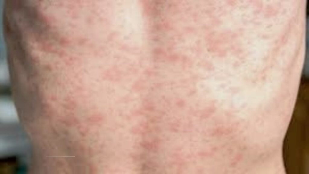 The Looming Threat of Measles: How Falling Vaccination Rates Could Fuel a Global Crisis