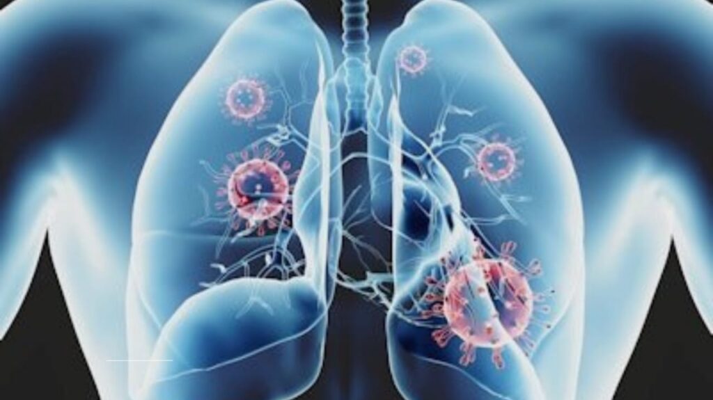 Pneumonia and COVID-19: Exploring the Link, Risks, and How to Stay Protected