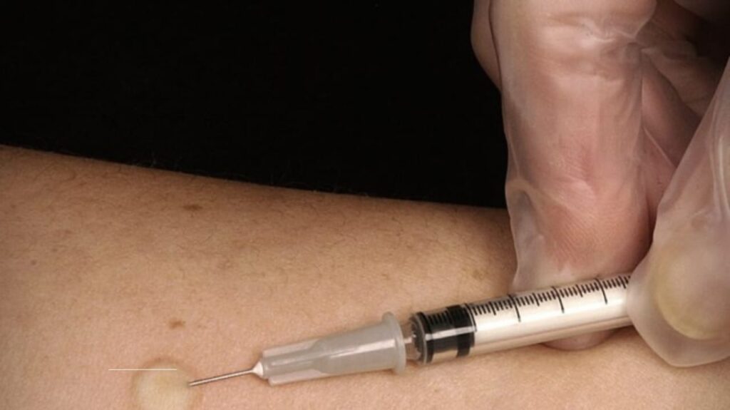 TB Testing: Skin Test vs. Blood Test Explained by Experts