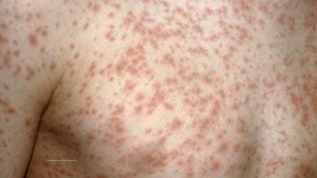 Measles Outbreak in Texas: Vaccination Trends, Risks, and Community Responses