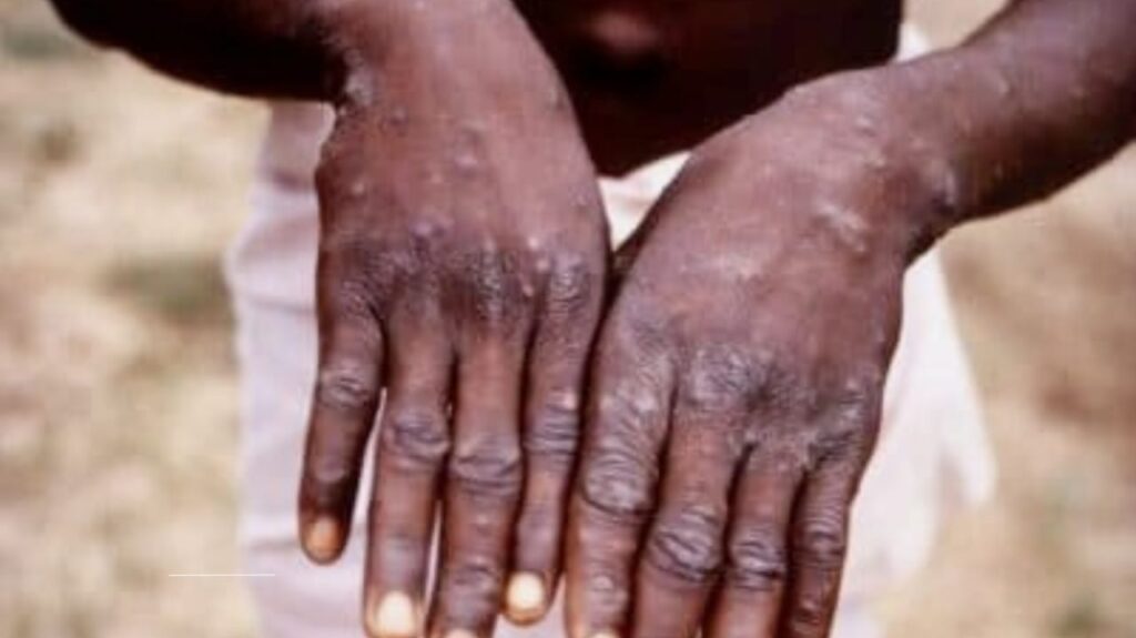 Should Mpox Be Called a Sexually Transmitted Disease? Transmission, Risks, and Expert Insights