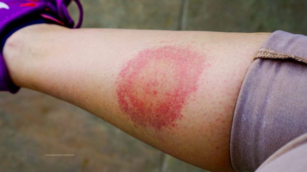 How to Prevent Lyme Disease: Expert-Backed Strategies for Outdoor Enthusiasts