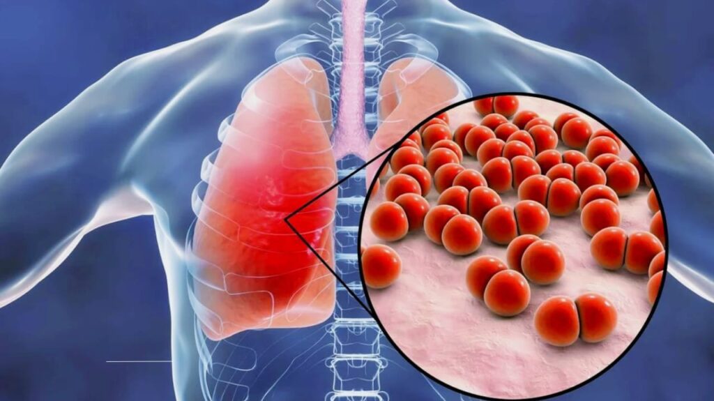 Pneumonia: Symptoms, Causes, Treatment, and Prevention Tips