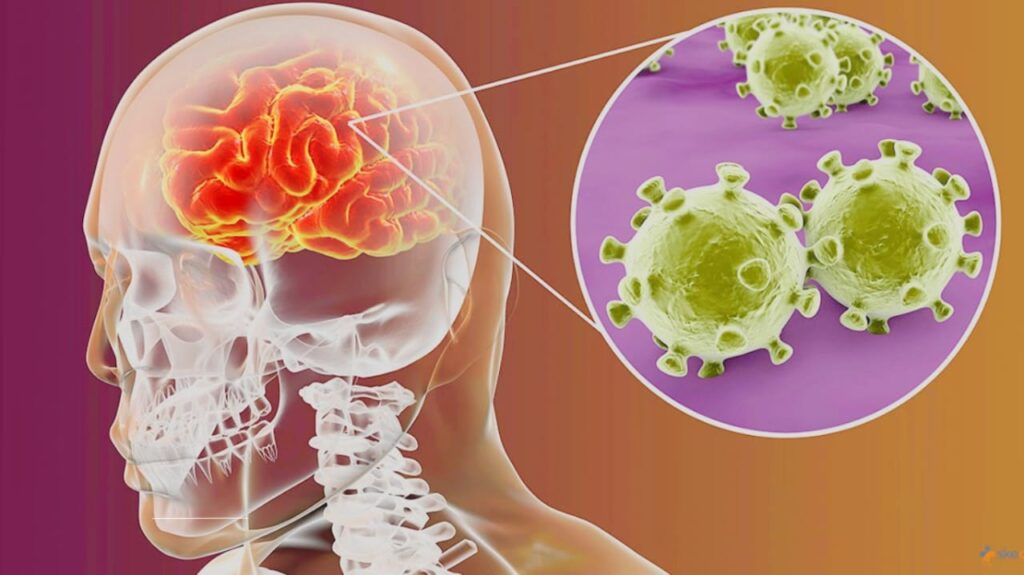 What Is Meningitis? Symptoms, Causes, and Treatment Options