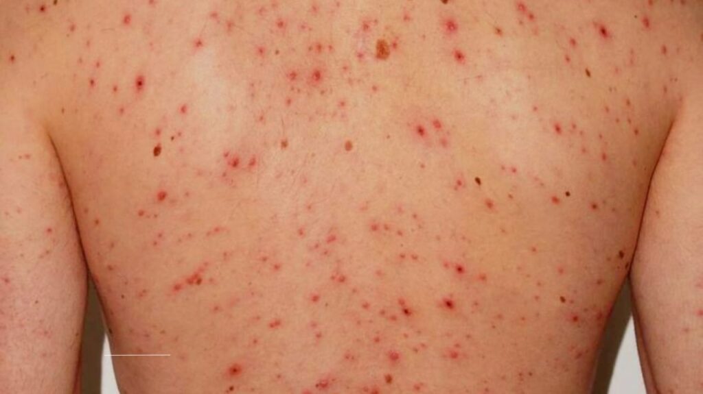 What Is Chickenpox? Symptoms, Causes, and Treatment