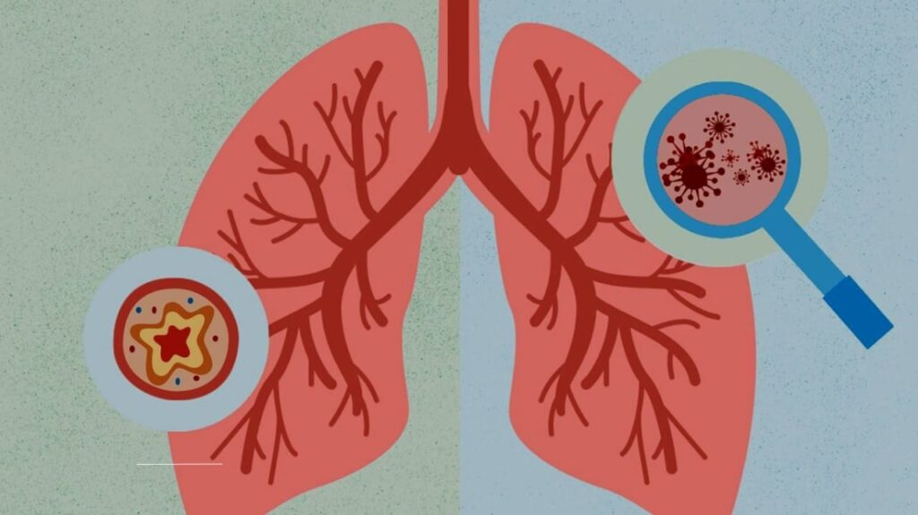Pneumonia vs. Bronchitis: What’s the Difference?