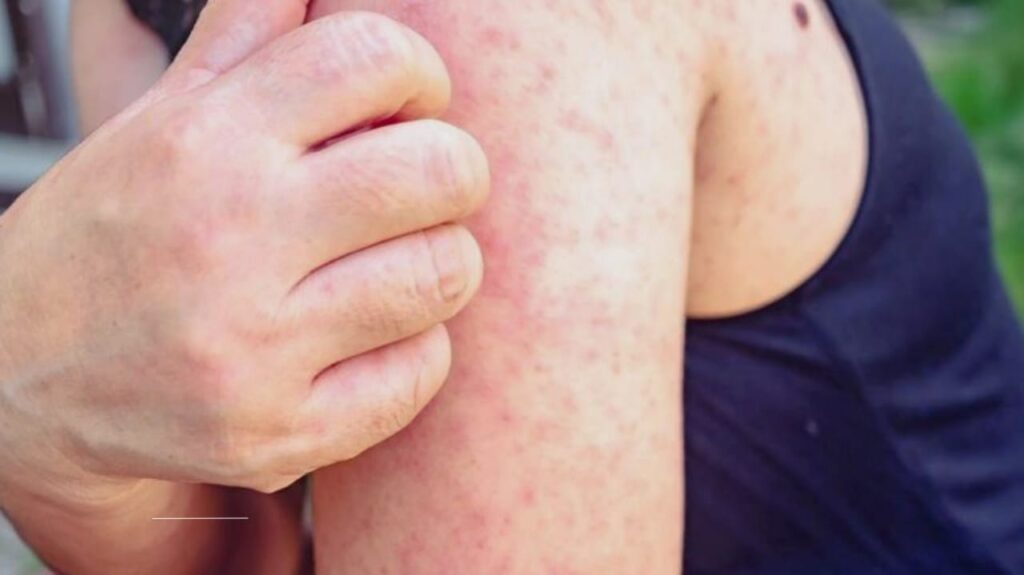 Measles Resurgence in New York City: What You Need to Know in 2025