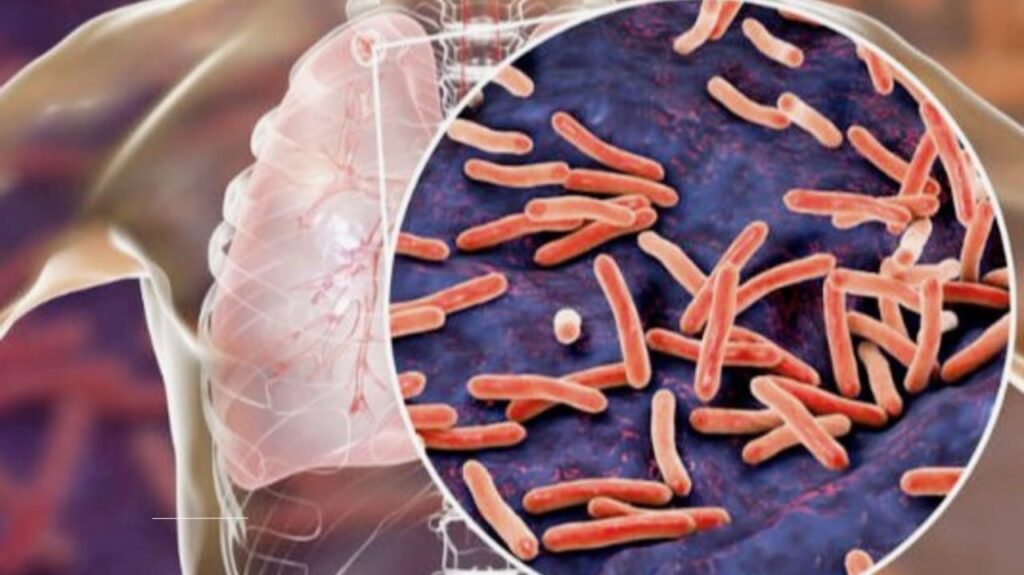 Why Is Tuberculosis Back? The Hidden Forces Behind a Deadly Resurgence