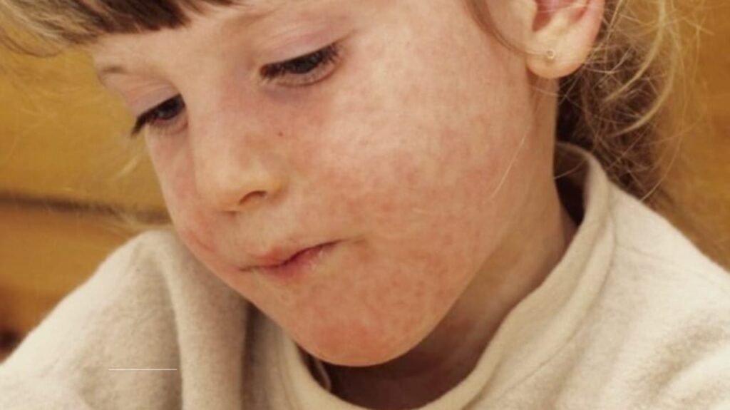 The 2025 Measles Outbreak: A Warning Ignited by Falling Vaccination Rates and Global Health Gaps