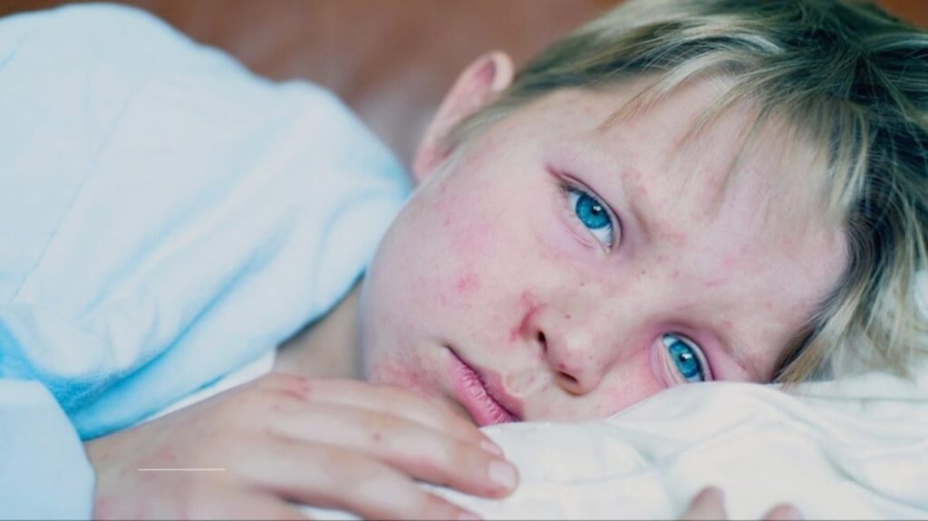 Measles Case Confirmed in Montgomery County: What You Need to Know