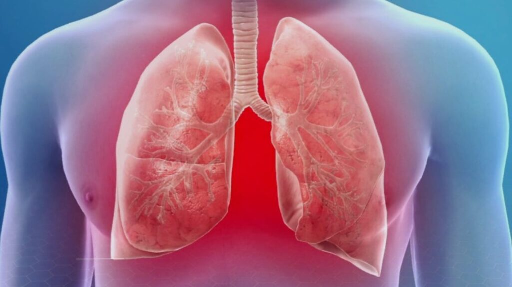 Pneumonia: The Silent Threat to Your Lungs—How to Spot It, Treat It, and Stop It Before It Strikes