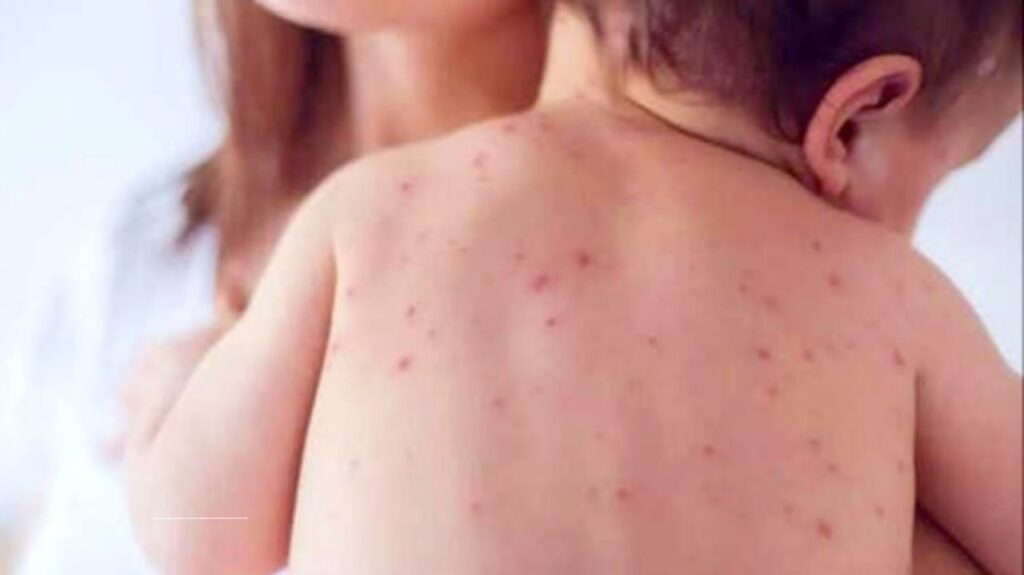 Measles Vaccine Hesitancy and Rising Outbreaks: Causes, Risks, and Solutions