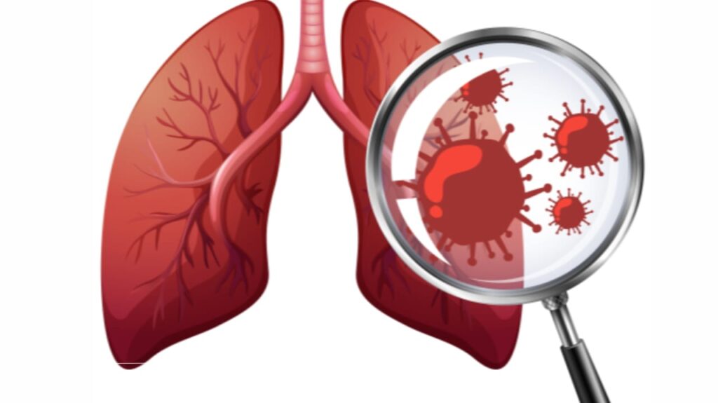 How to Prevent Pneumonia: Expert Tips on Vaccines, Lifestyle Changes, and Boosting Lung Health Naturally