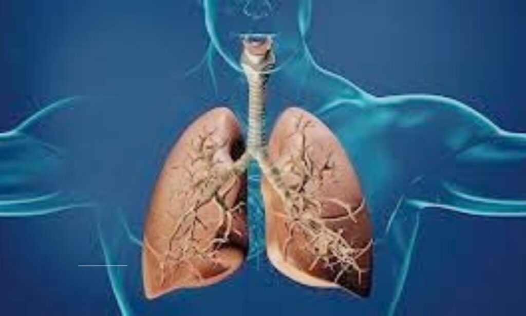 "Effective Pneumonia Treatment Options: Medications, Therapies, and Recovery Strategies Explained"