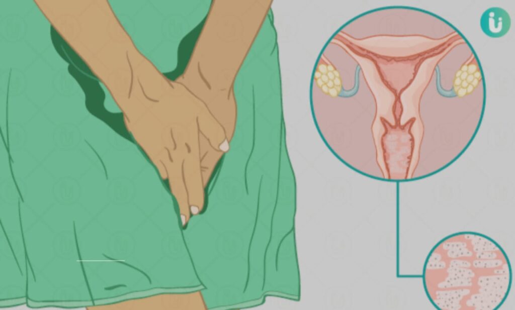Vaginal Yeast Infections: Symptoms, Treatments, and Prevention Tips for Quick Relief