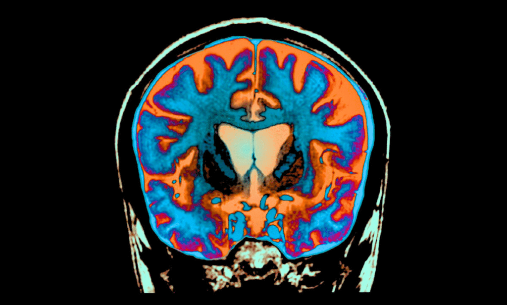 New Hope for Huntington's Families as Treatment Slows Progression.