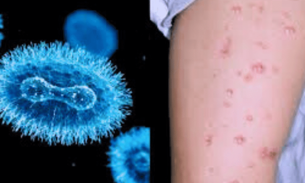 Mpox Clade Ib Strain Spreads in Europe: Why Vaccination Matters Now