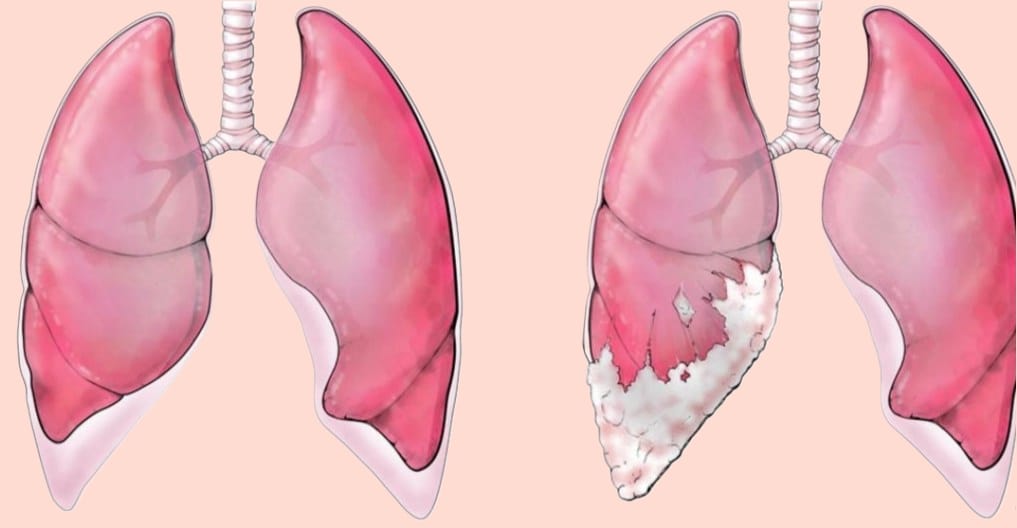 Mesothelioma, Keytruda, Multiple Myeloma: Breakthrough Insights Transforming Modern Cancer Care