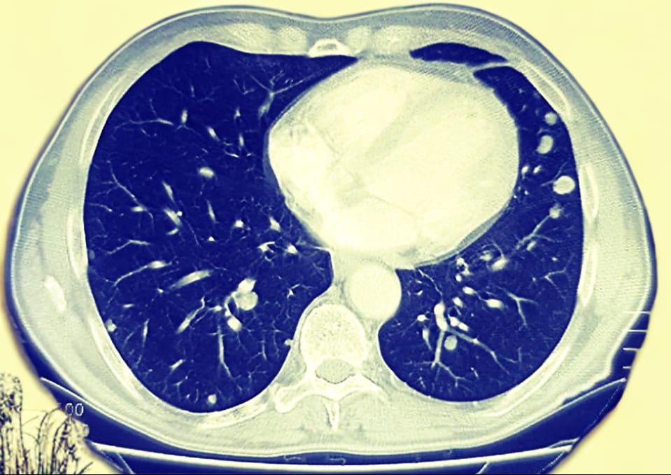 Lung cancer screening rates