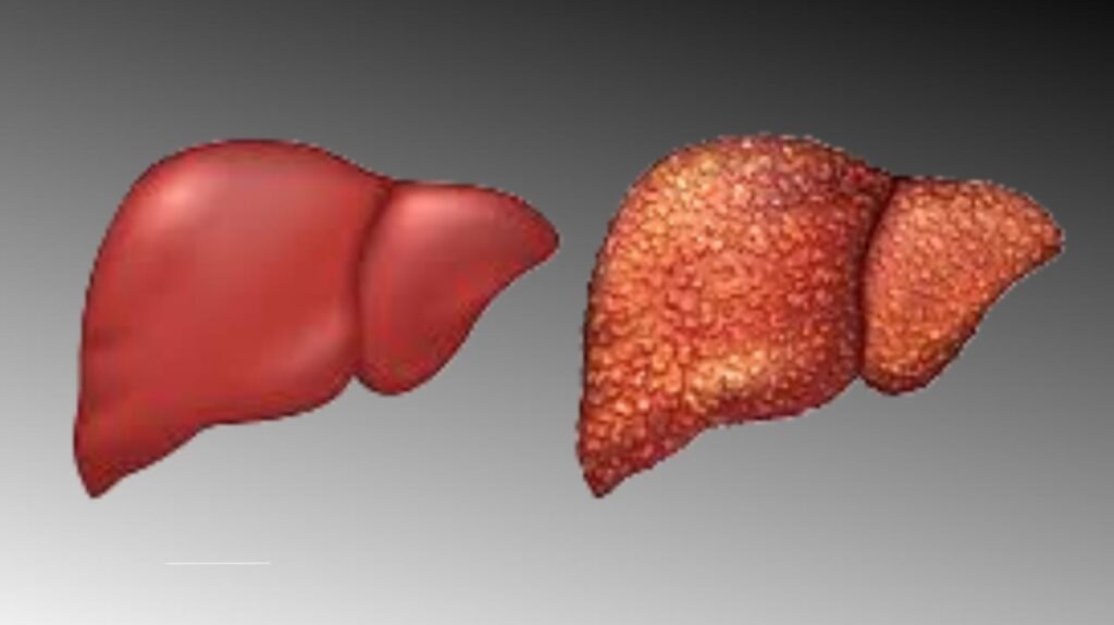 Cirrhosis of the liver
Liver cirrhosis symptoms
Portal hypertension
Hepatic encephalopathy
Liver transplantation
Chronic liver disease
Alcohol-related liver damage
NAFLD cirrhosis
