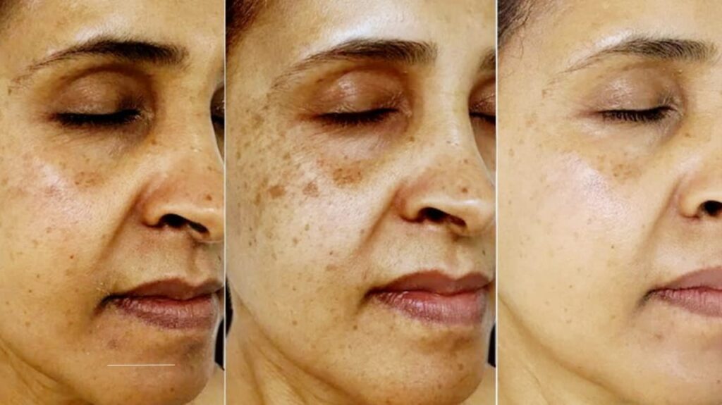 liver spots
age spots
hyperpigmentation
skin discoloration
