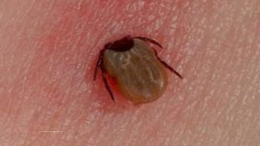 Lyme disease symptoms often overlap with other conditions, leading to frequent misdiagnosis. This article explores five illnesses commonly mistaken for Lyme disease, including fibromyalgia, chronic fatigue syndrome, multiple sclerosis, rheumatoid arthritis, and lupus. Learn the key differences, 
diagnostic challenges, and expert insights to improve accurate identification and treatment.