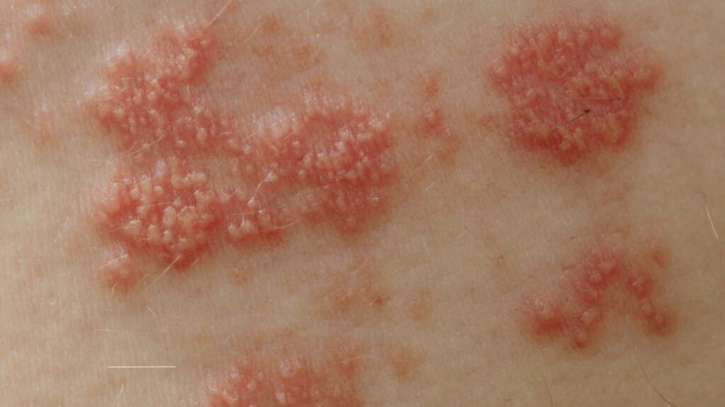 shingles without chickenpox, varicella-zoster virus, chickenpox vaccine, shingles risk, shingles causes
