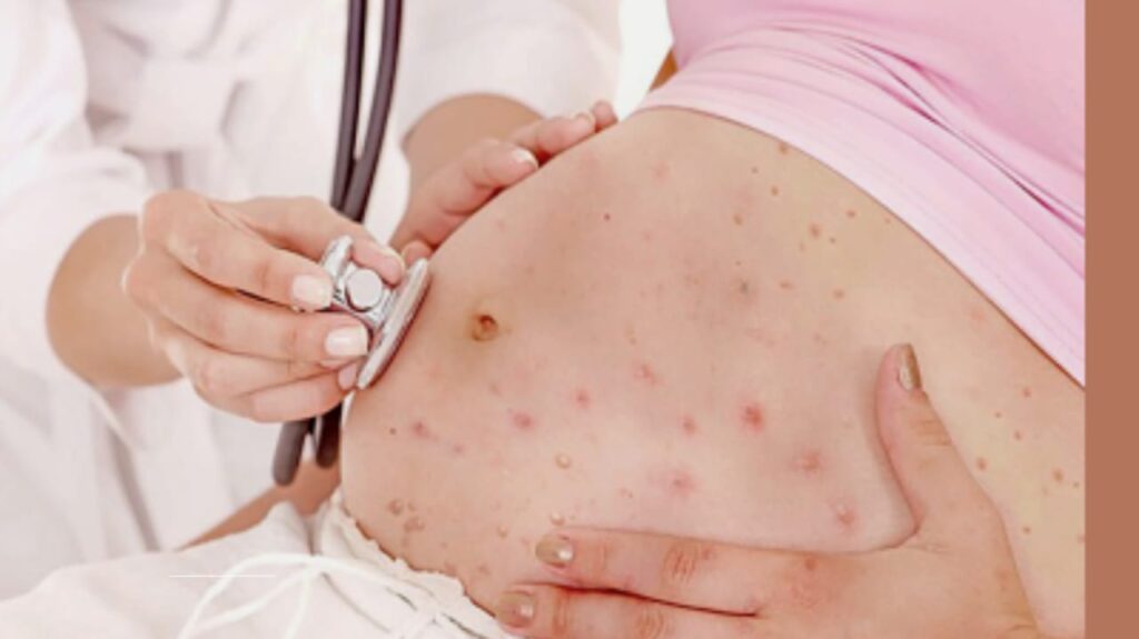 An in-depth guide on chickenpox during pregnancy, covering risks, complications, prevention strategies, and treatment options to protect both mother and baby.