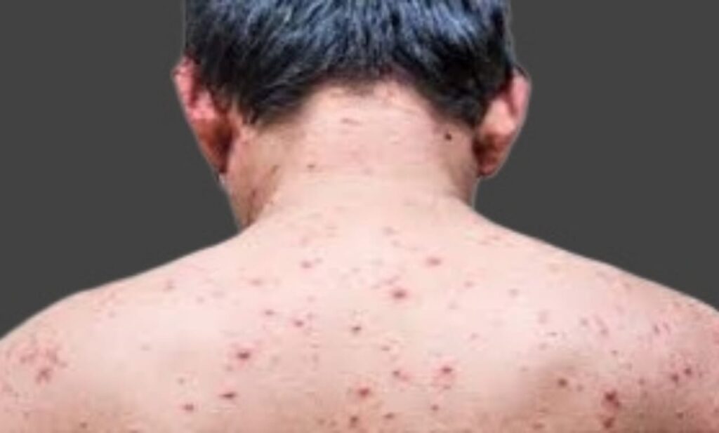 Chickenpox transmission prevention tips to avoid infection spread.