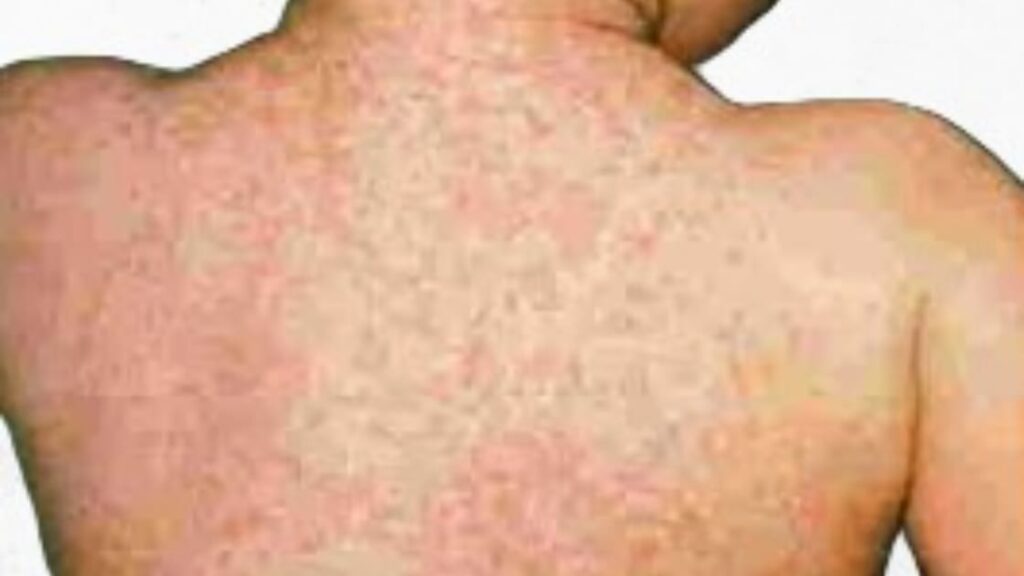 Measles outbreaks surge: Vaccines critical across 10 states.
