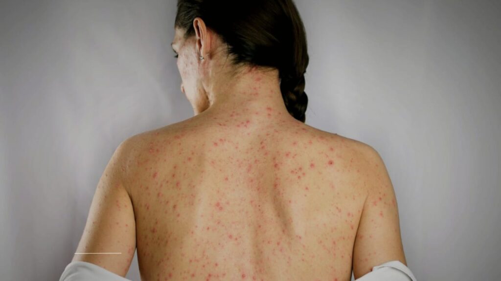 Texas measles outbreak linked to low vaccination rates.