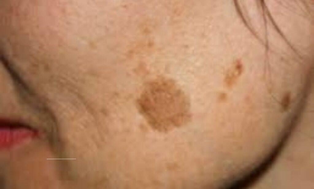 AI technology improving skin cancer detection and diagnosis accuracy.