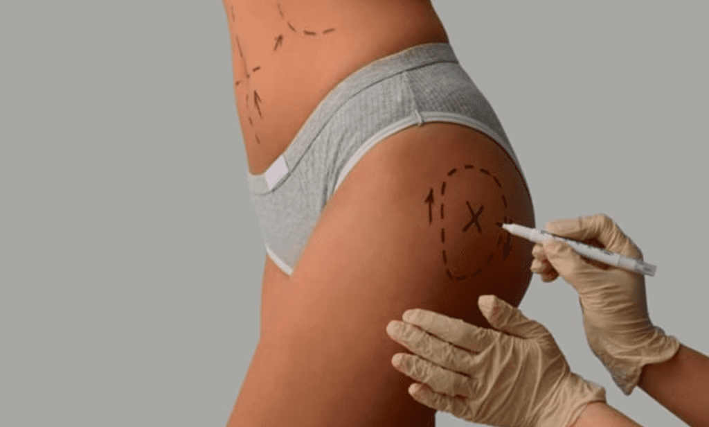 Surgeons reveal BBL risks: smell signals danger.