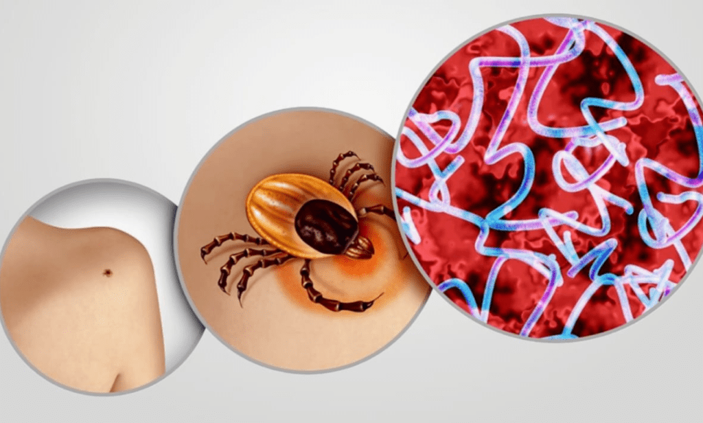 Stop Lyme disease: essential summer tick bite prevention steps.