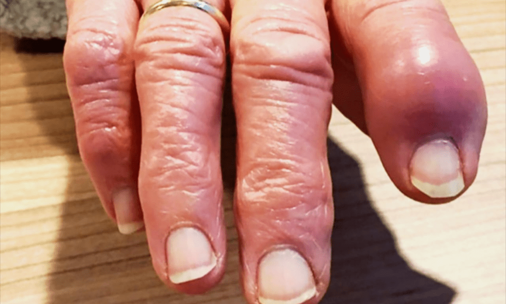Swollen fingers reveal rare bone-destroying lung cancer