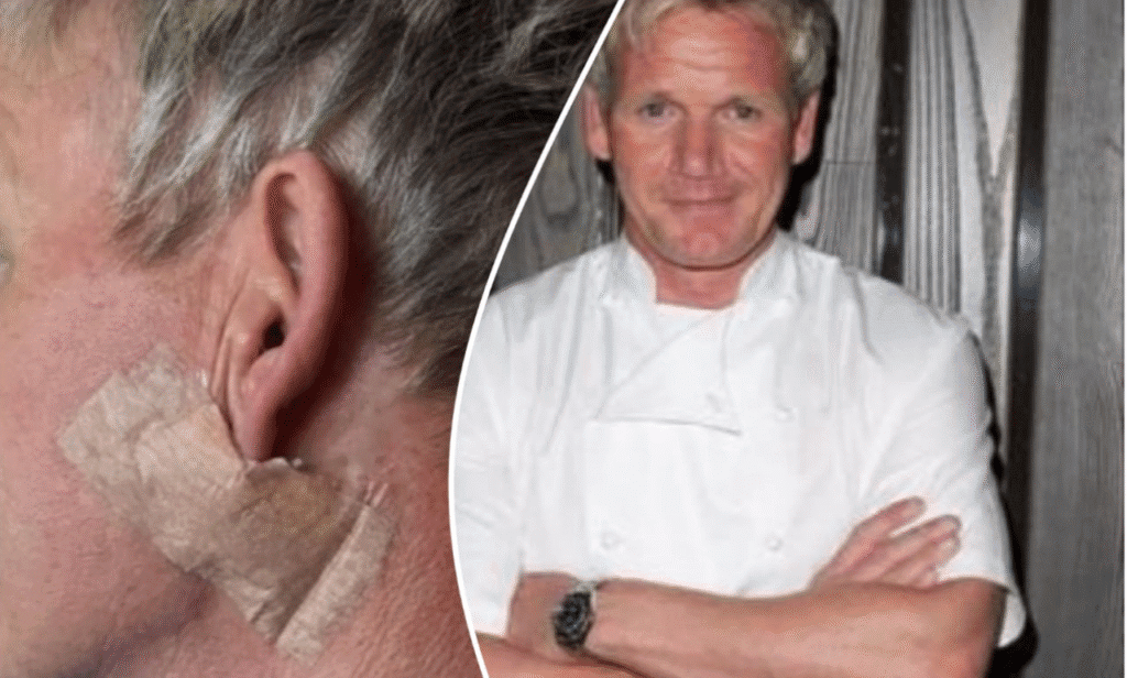 Gordon Ramsay shares skin cancer story to promote awareness.
