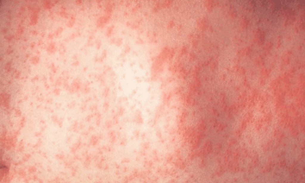 Measles complication SSPE leads to tragic child death.
