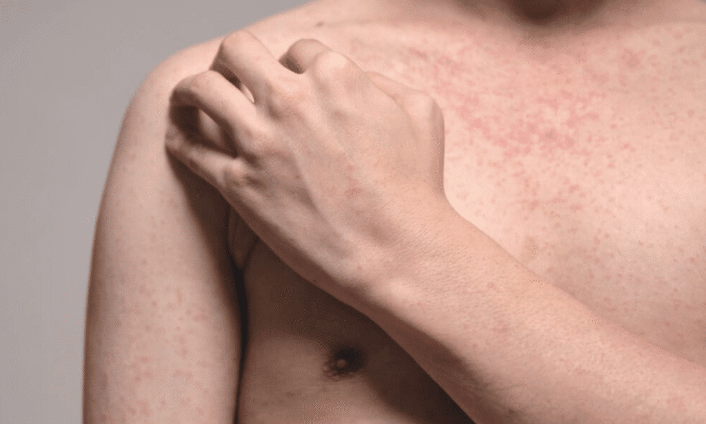 A map and chart showing recent measles outbreak case clusters.