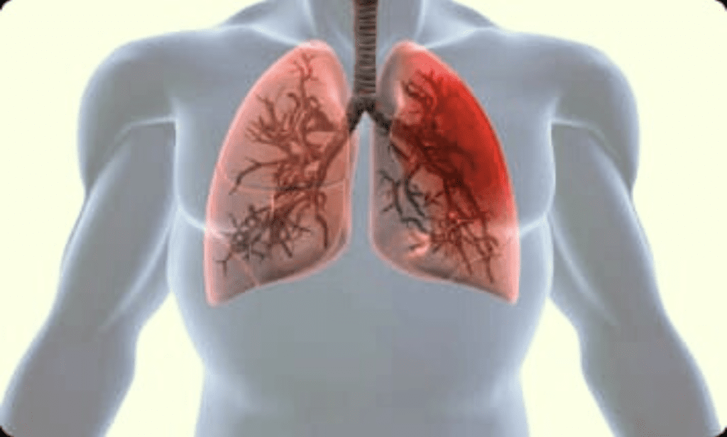 Mesothelioma Keytruda multiple myeloma